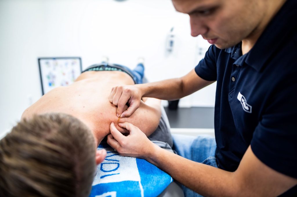 Dry needling | De Fysioclub